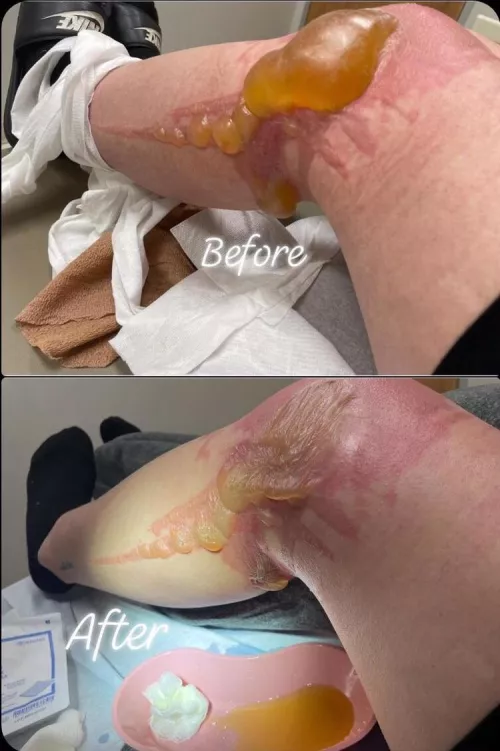 Found in a medical gore subreddit by Missveexox13