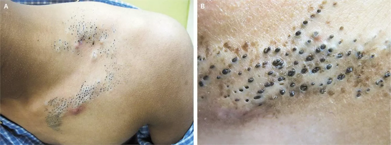 Found in /trypophobia ... Would love to see these extracted by MudgyNdaPigs