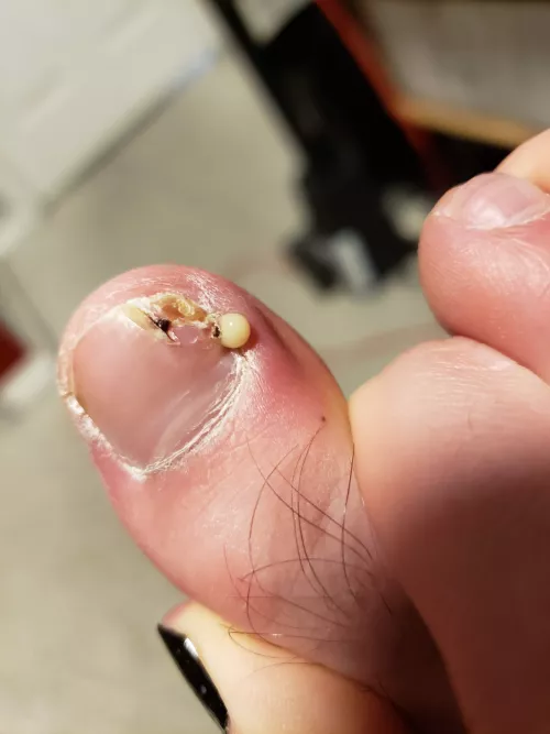 Found this fun little surprise while caring for an ingrown toenail from running a marathon. Made it all worth it by MaroonSavage