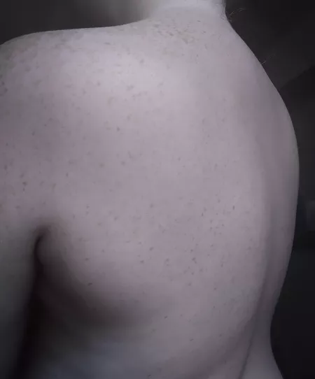 freckle queen by freckledxxfreak