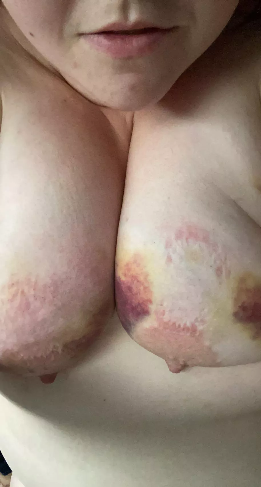 Fresh bite marks and old bruises… posted by g22p