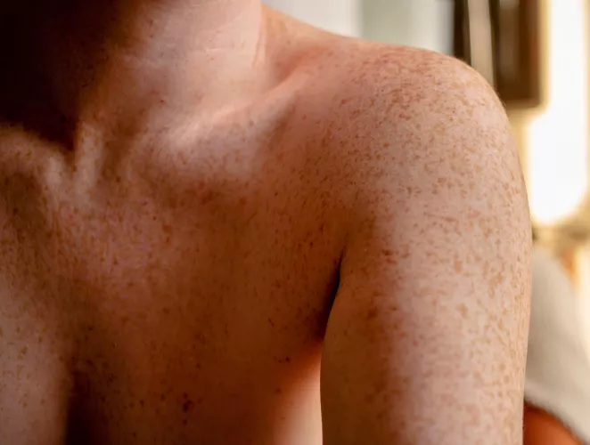 Fun Fact: ephelides (or ephelis) is the medical/greek term for freckles. by frecksfordays