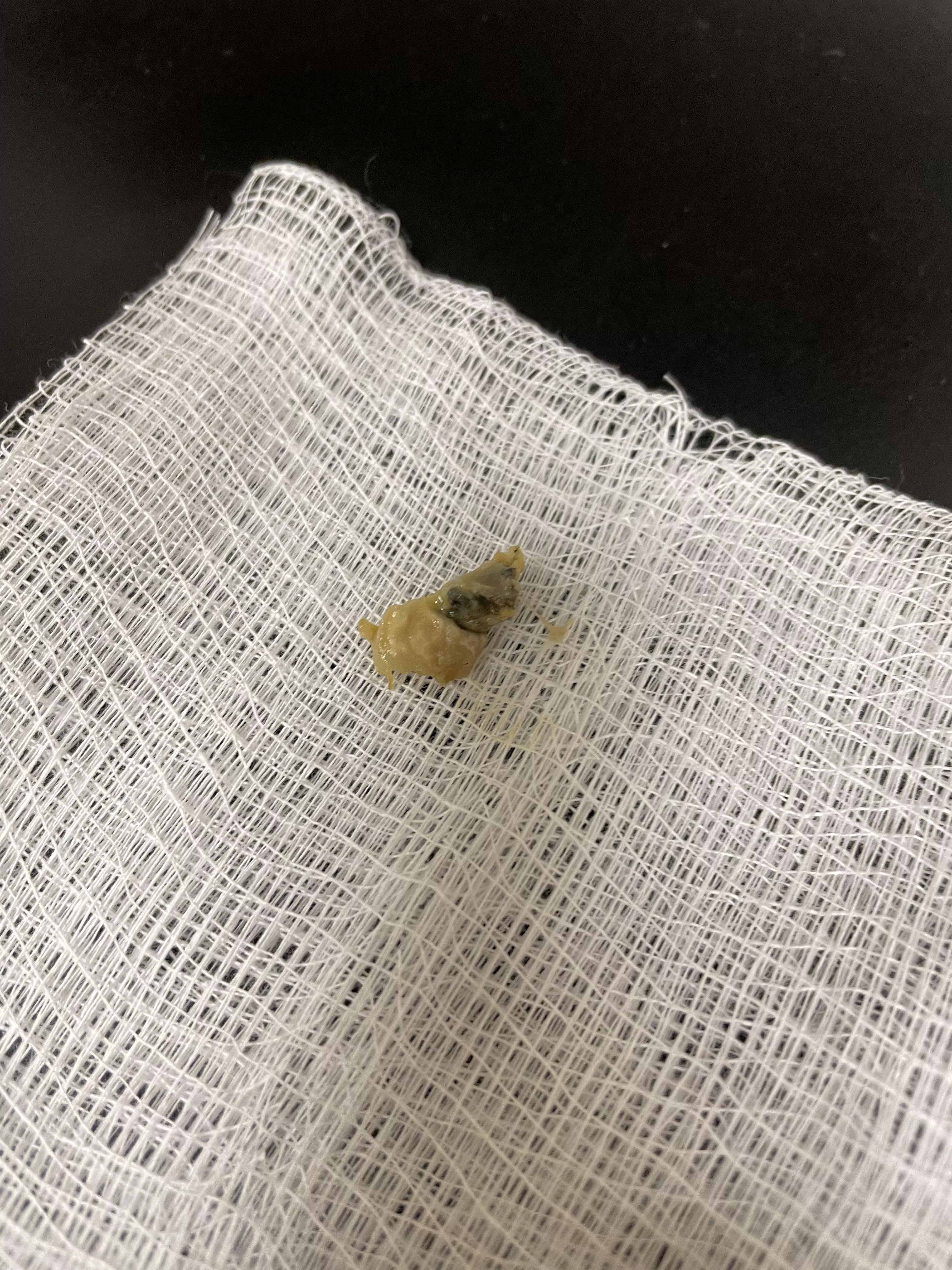 Fungal and pus plug extracted from my ear. Infections suck. posted by OwnMeBell
