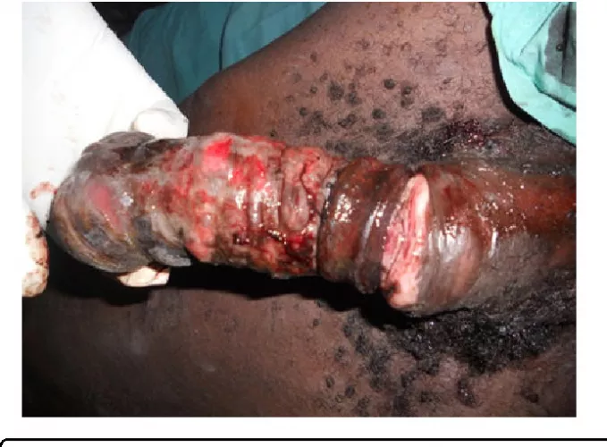 Gangrene of the Penis due to Strangulation by a Metallic Ring: A Case Report by GamingKarma