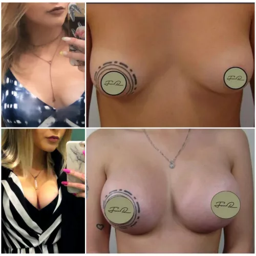 GF before nad after 650ccs! What do you think? by restauranttesty