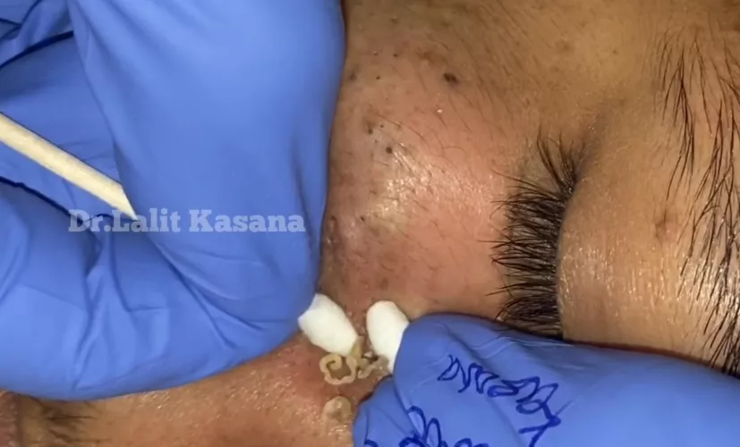 Goldmine of deep Blackheads (Dr.Lalit Kasana) It’s a repost but we’ll worth another watch! Link in comments.. by Hunni_Bee