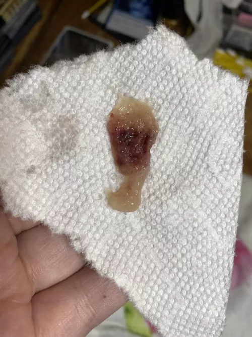 Got the Rona and good god, this god awful thing was stuck in my nasal passages for 4 days. Got it out today and I could finally breath! by ShinnyCrab
