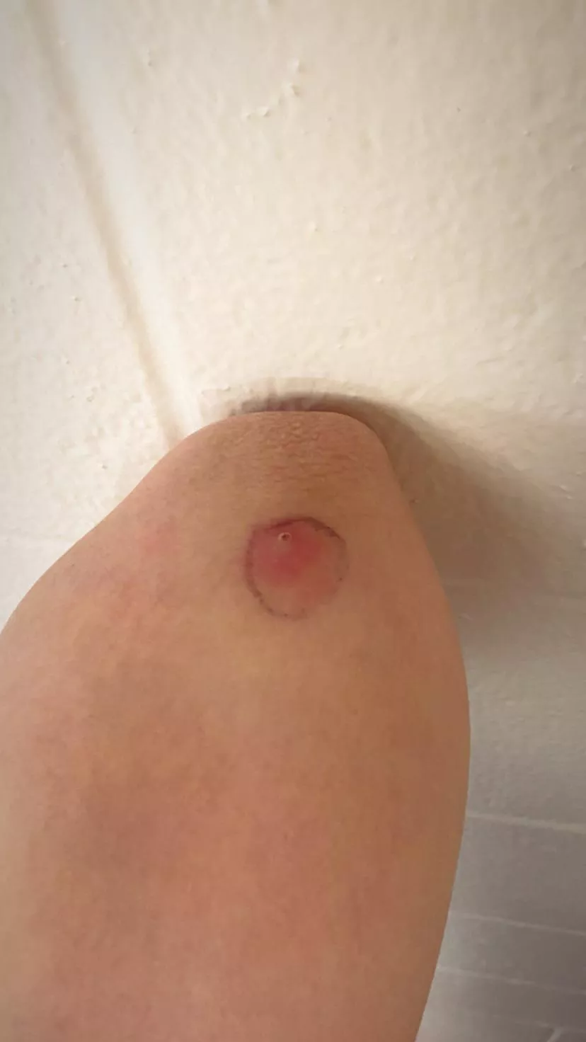Gotta be careful with what you pop. Ended up with cellulitis (recognized cause this sub!) I’m on antibiotics now. posted by smafreebird