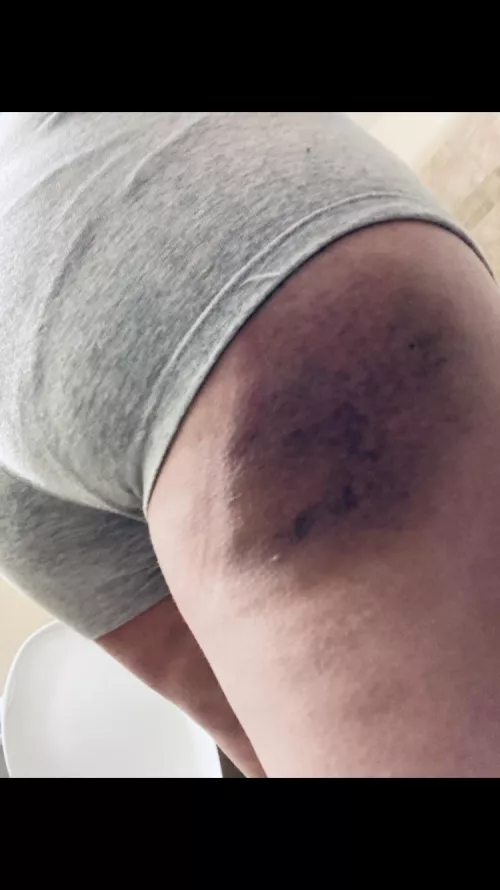 Gotta love a good bruising <3 by Jayyd23