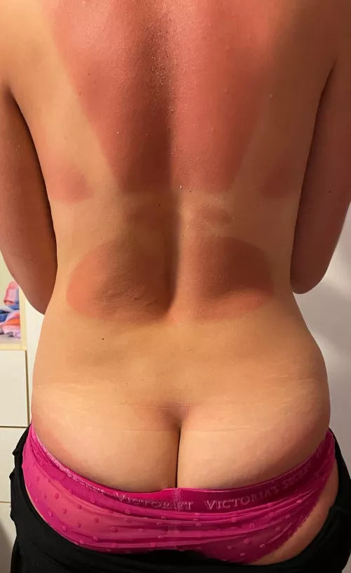 Guess I got carried away on vacation with no sunscreen by HeatherHopeful