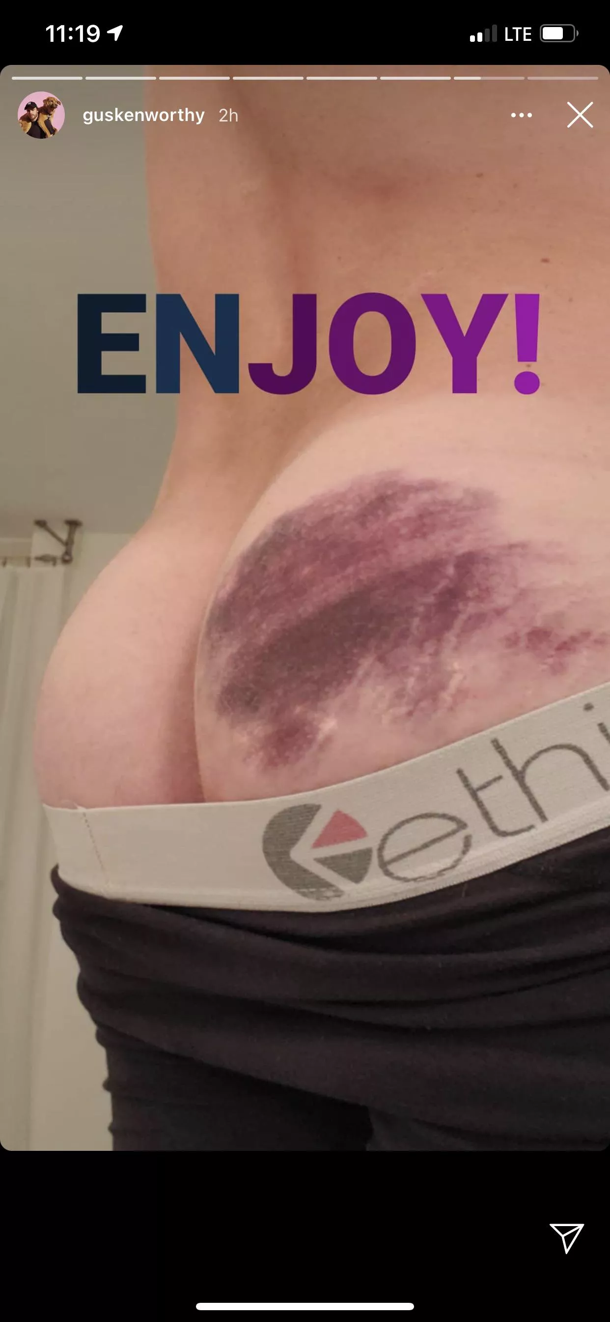 Gus Kensworthy via Instagram Story (Bruised Butt) posted by homiesexuality