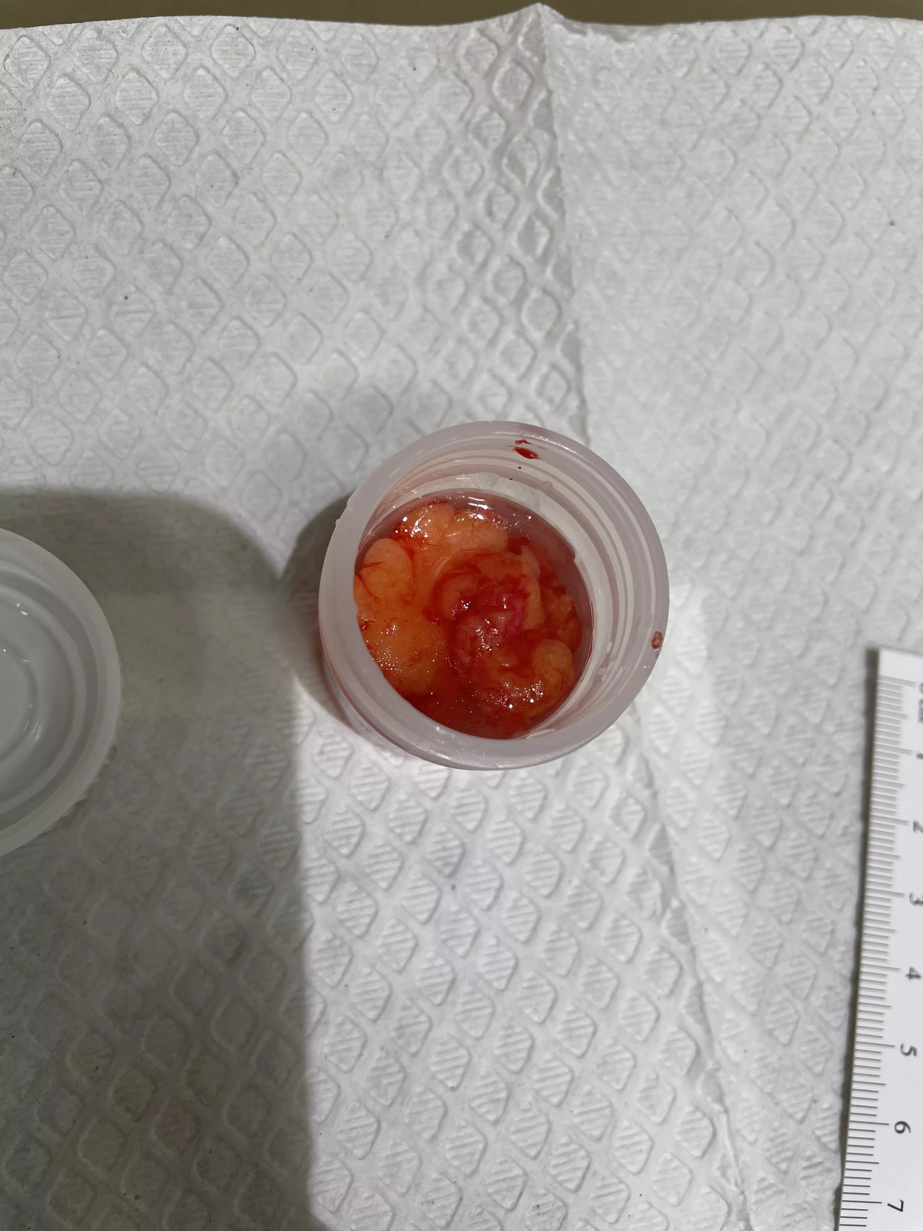 Had a lipoma removed today. Three total in one spot. He just kept digging. posted by samshady_9