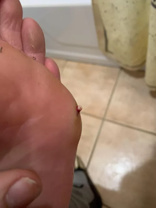 Had an infection in my foot, this was the last pop that made me able to walk pain free again by jswanderulo1