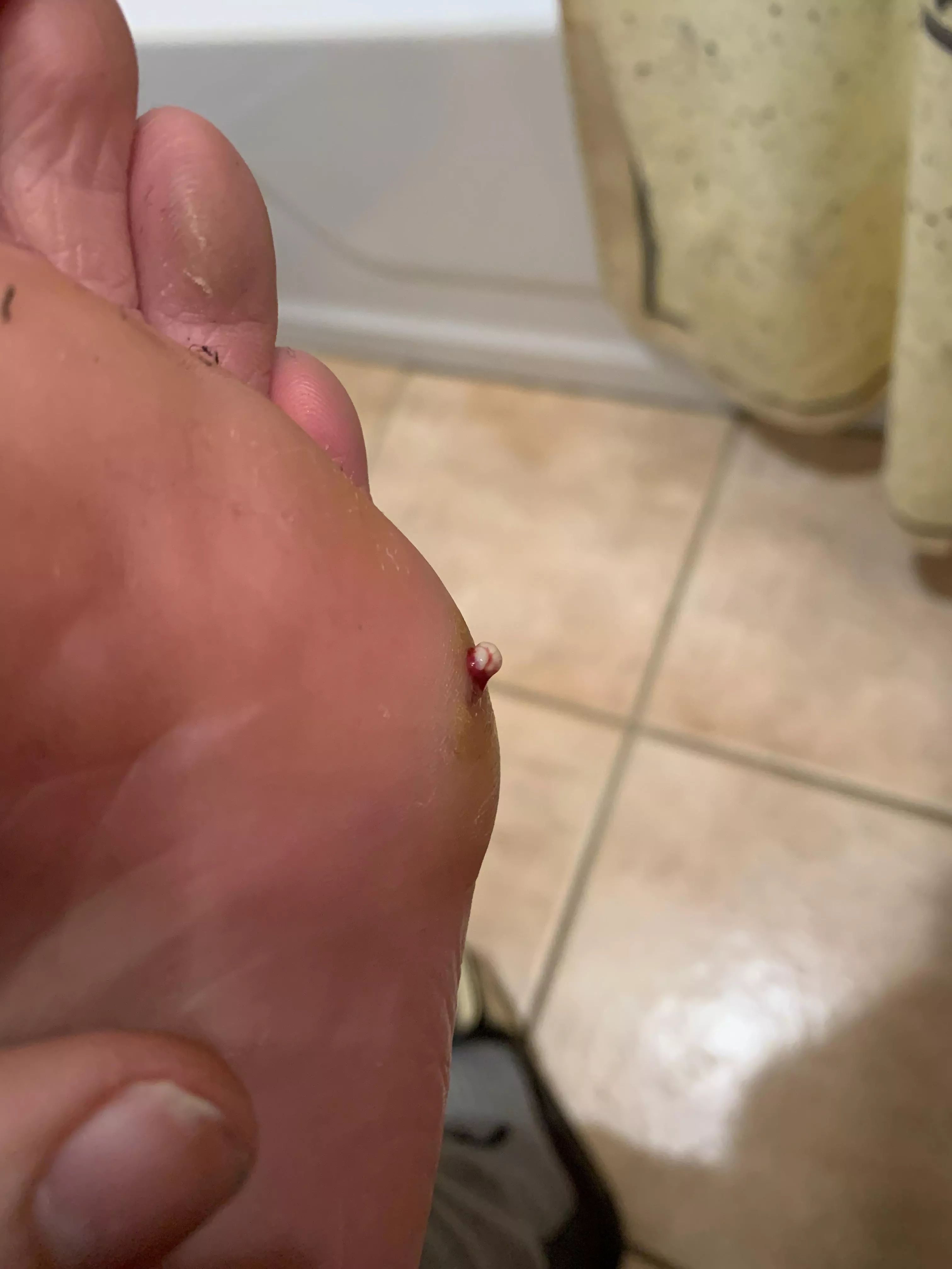 Had an infection in my foot, this was the last pop that made me able to walk pain free again posted by jswanderulo1