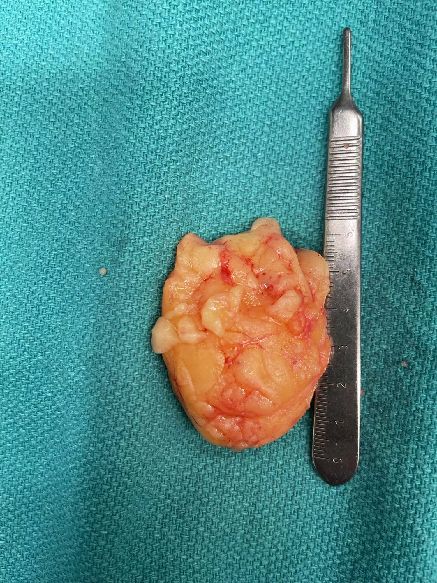 Had this big Bertha removed today. Wish I had it on video. It was in there good. posted by Sweetgirl82