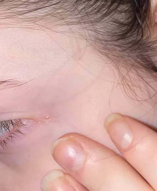 had this for about a decade now. it hurts too much to pop but the urge has been quite strong lately by idkwynter