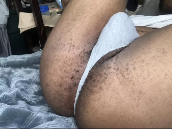 Hairy ! Hairy ! by Austincrazyguy