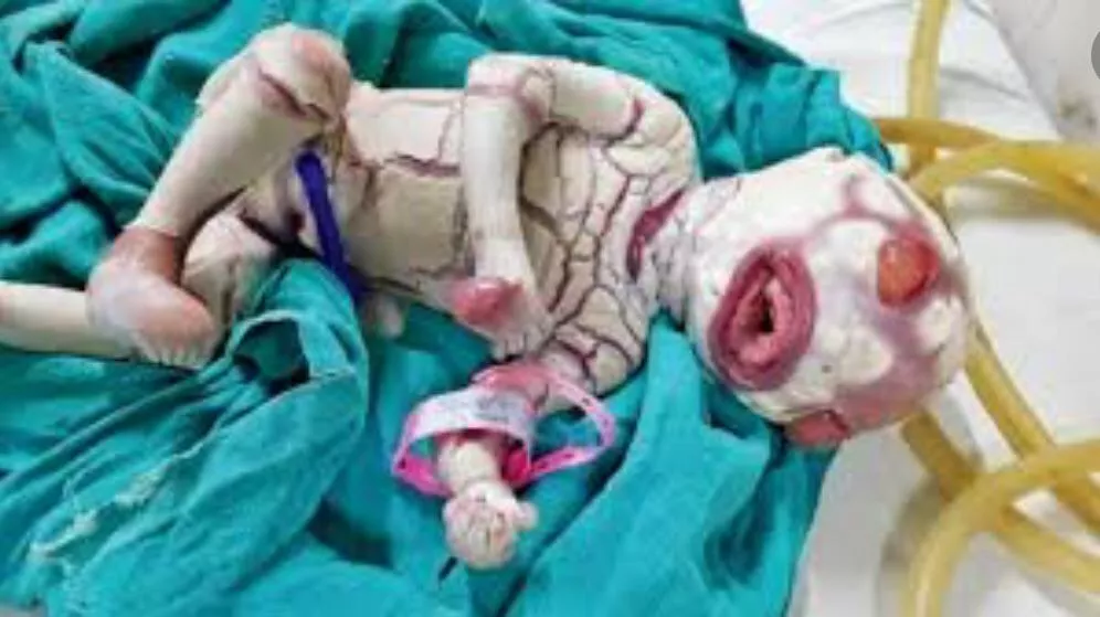 Harlequin ichthyosis in a baby posted by zivinkxter