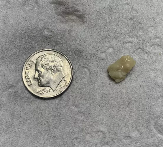 Huge tonsil stone I removed from my throat (from COVID-19) by rdwtoker