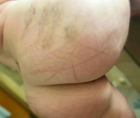 I absolutely love his marks on me by nursenj2014