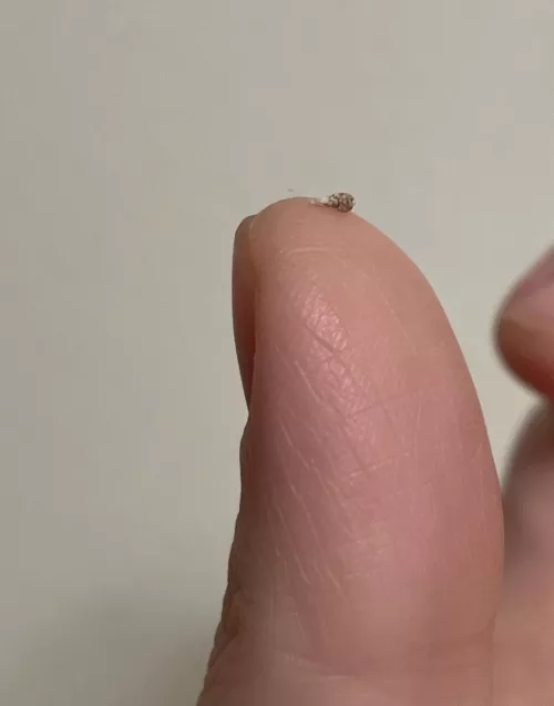 I accidentally scratched the pimple on my head (maybe an infected hair follicle, not sure) and when I squeezed it, this hard thing popped out. by mama_lu0831