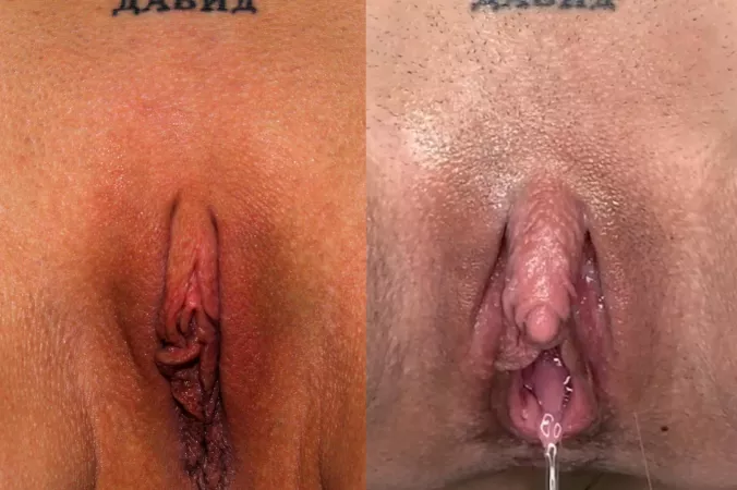 I always love sharing before & after pics of my big clit enlargement. Look how far I’ve cum! 🤤😈 by theeuroslut