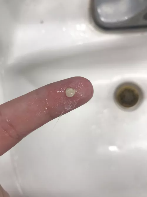 I have extremely small tonsils, to the point the ENT dr thought I’d had them removed. Combined with an overly sensitive gag reflex, I’ve never been able to remove the stones, just suffer through them. Tonight I finally got one out! by fishebake