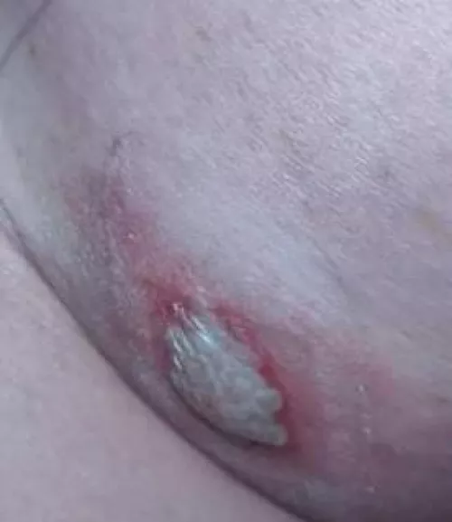 I have shingles, again. by dd80sd81