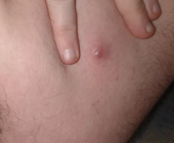 I just found a giant unpoppable zit on my inner thigh.. it's absolutely giant and mainly under the surface. very tempted to cut it open but am trying to stop myself by vinylveins