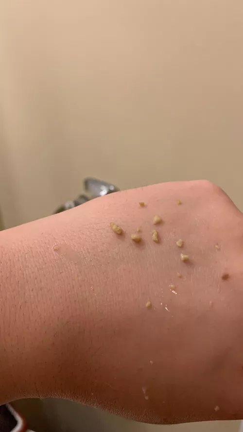 I just got over a head cold and had the ~grossest~ tonsil clean-out ever 🤢 by professorcupcake2