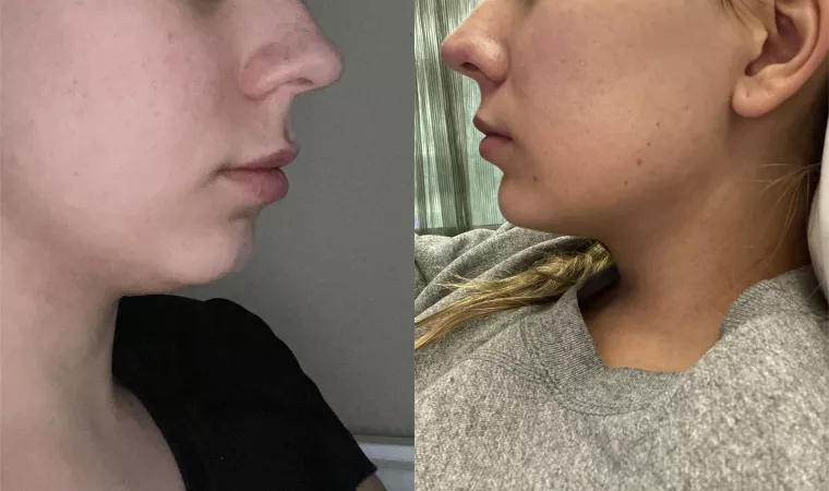 I know that people really love lip filler here, but I decided to show off my chin filler before/after too in case any bimbos are curious! by slutmeup