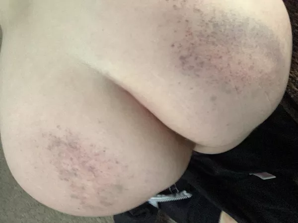 I love my bruises after a scene 😍 [F] by FancyScience