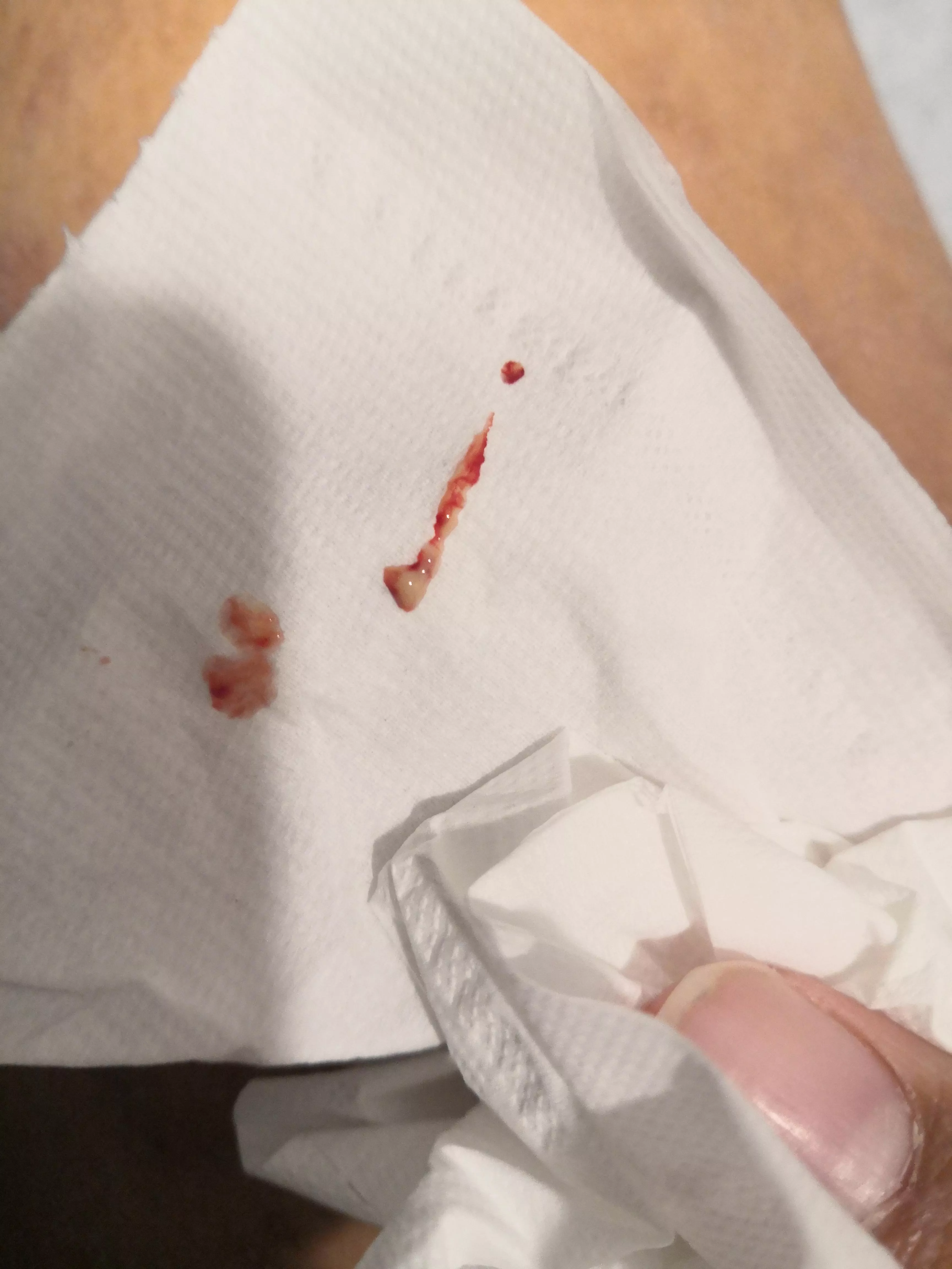 I popped a bumb on my penis stem... posted by hiaussiemq