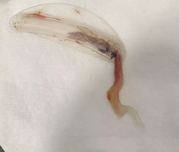 I recently had a septoplasty, it felt like I was pulling part of my brain out. by Sixdogsinalabcoat