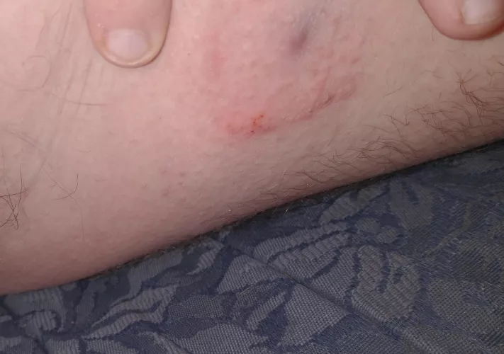 I used a hydrocoiod bandaid on a pimple, and drianed a lot out, pretty sure the purple is just scar tissue / bruising. but now I'm having a bad blister reaction to the adhesive! by vinylveins