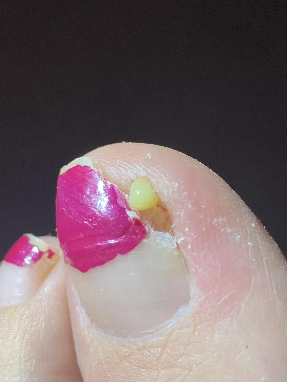 Ingrown toenail pus? posted by iSayBaDumTsss
