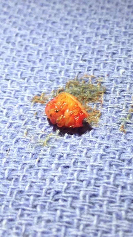 Inside of a Skin Mole by zhukob