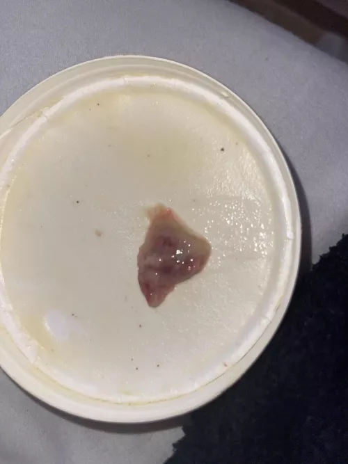 just coughed this up, have a horrible throat & sinus infection, haven’t been able to breathe properly for 2 days now, coughed this up and felt immediate relief by cheeselover214