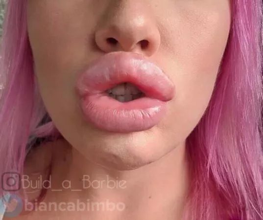 Just filled my lips again! Can’t wait to go bigger! by BimboBabyBianca