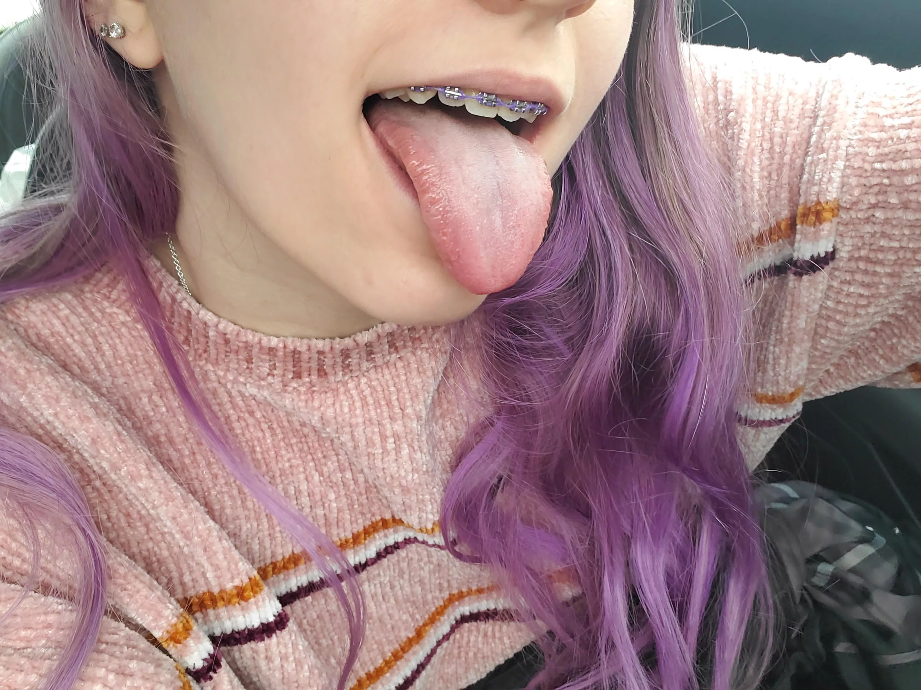 just got my braces color changed to purple 💜 posted by lise_peach