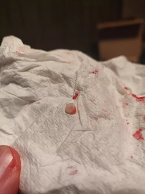 Just squeezed this out of my arm by Xmic6538