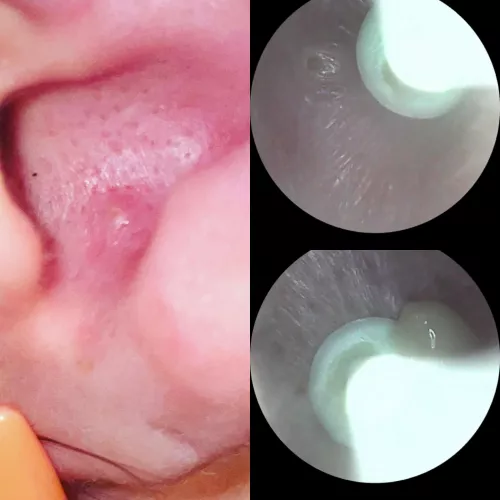 Kept telling myself it wasn’t gonna pop yet so not to record. Was gonna give it another day so it would be bigger for y’all.I barely touched it & boom a squirter. I feel like I let y’all down. by Chelsey_alise