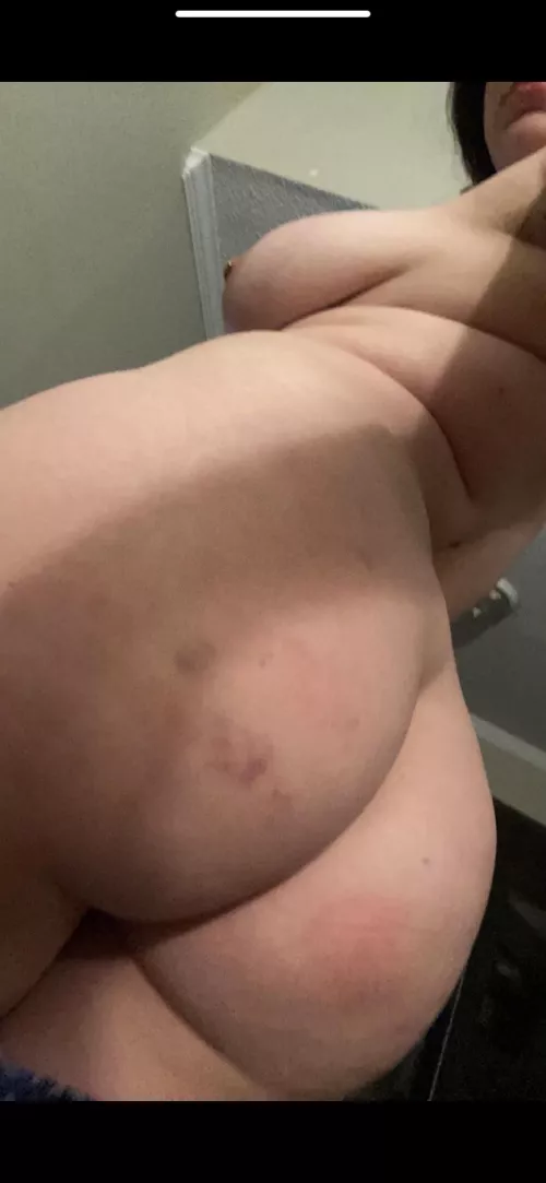 left nice and bruised [f] 🥰 by vagabondage_420