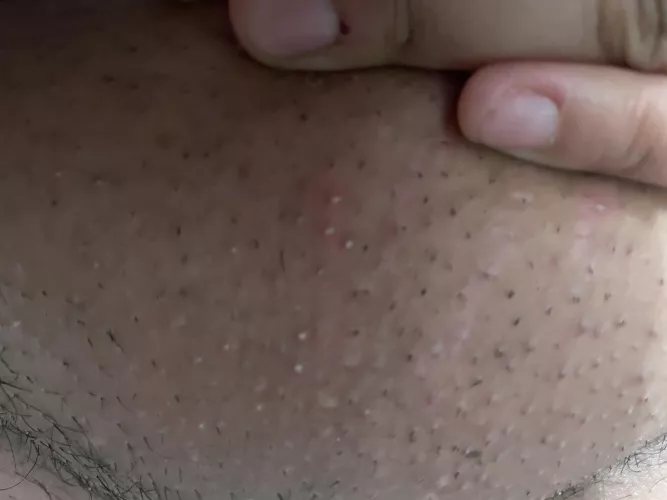 “let’s try an expensive shower razor over the electric razor” shave burn. Never again! And I missed a ton! Warm compress helped tho. by OwnMeBell