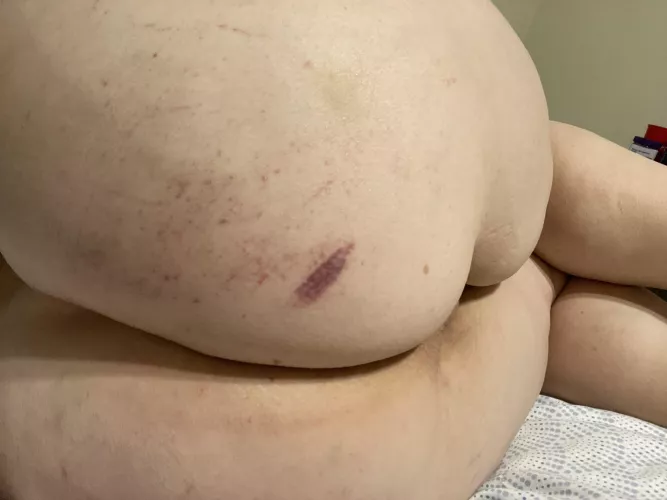 Like my mark from my spanking by daddiegurl74