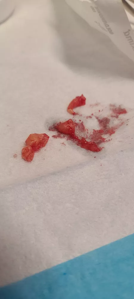 Lipoma removed from groin by krazy_chick195