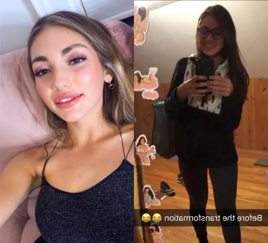 Literally minutes afrer my (f22) lip injections, theyll be less swollen in a few days by phrasefunding