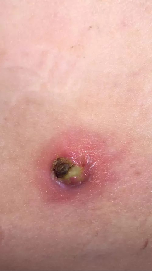 Lovely boil. Had to have it taken medically treated and turns out it was MRSA positive. I named it Mr. Sa. by smdhenrichs