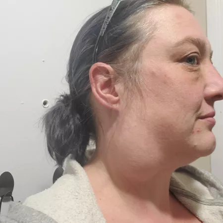 Meet Pete. Help me Yeet Pete? 11 (forbidden pop branchial cleft cyst) by JynxGirl