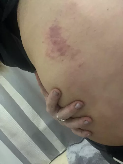 Might not look like much , but this welt has its own heartbeat , central nervous system and zip code . This smack made my body have aftershocks way after it happened . P.s. I didn’t squirm this time. I knew better by gardeniachick